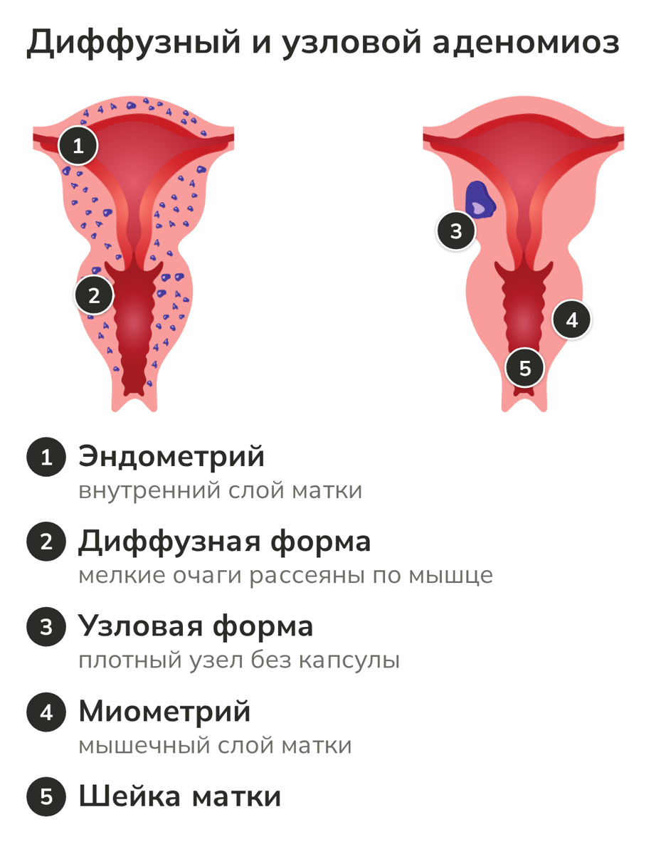 Схема матки: диффузная и узловая формы аденомиоза