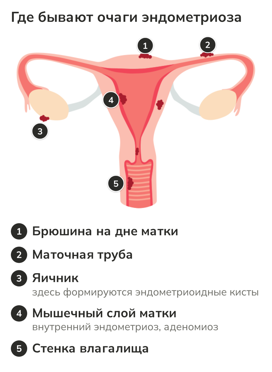 Схема матки с придатками: где бывают очаги эндометриоза