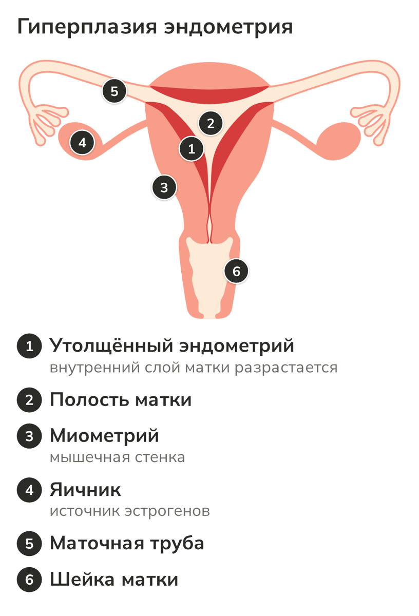 Схема матки с утолщённым эндометрием при гиперплазии