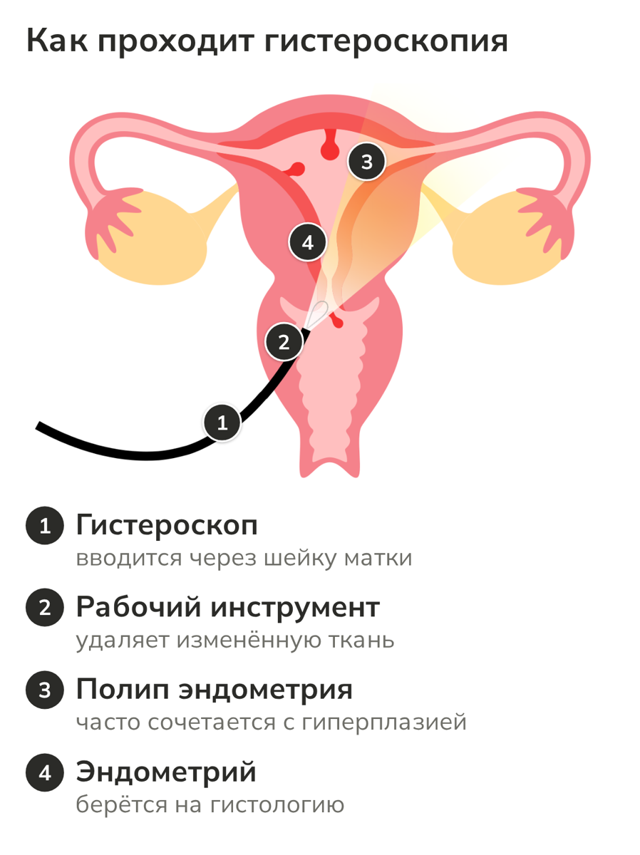 Схема гистероскопии: осмотр полости матки и удаление изменённой ткани