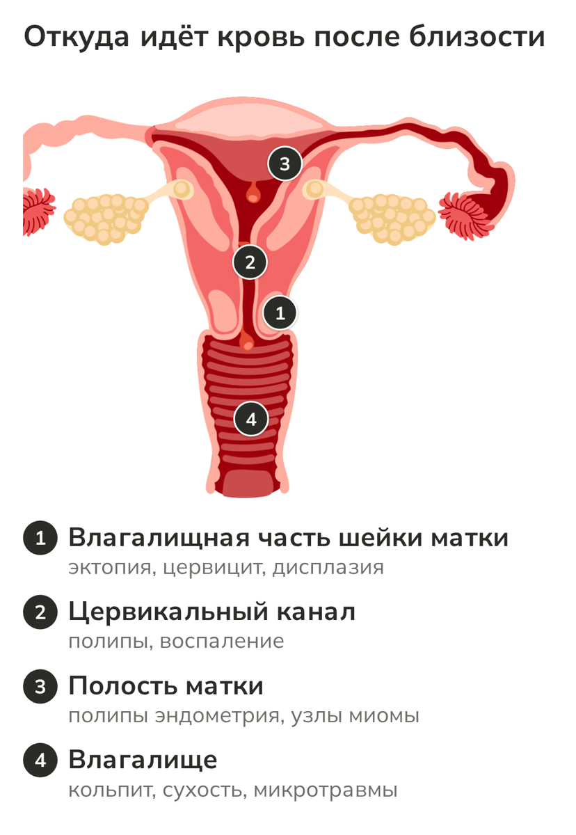 Схема матки и влагалища: возможные источники крови после полового акта
