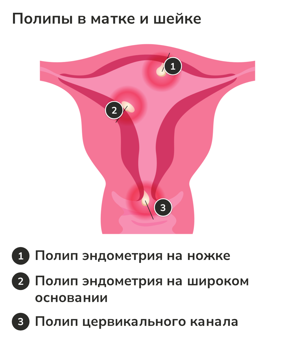 Схема матки: полипы эндометрия и полип цервикального канала