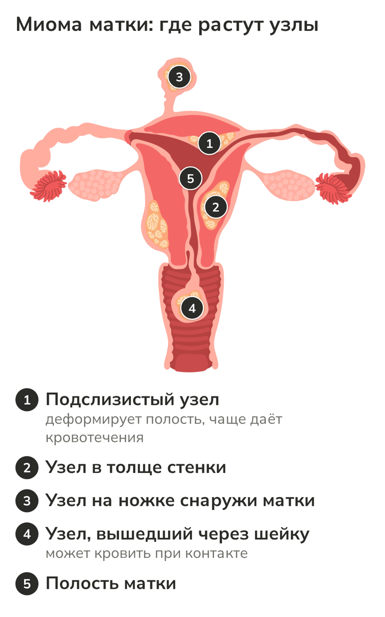 Схема матки: расположение узлов миомы, которые могут вызывать кровотечения