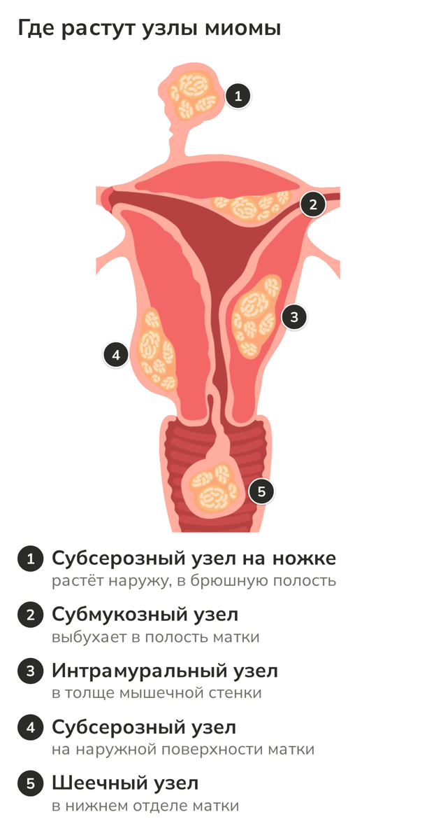 Схема матки: где располагаются узлы миомы