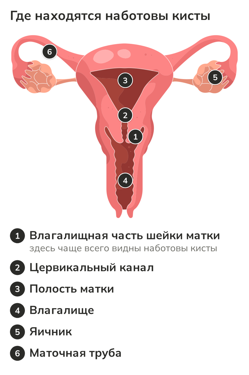 Схема матки и шейки: где образуются наботовы кисты