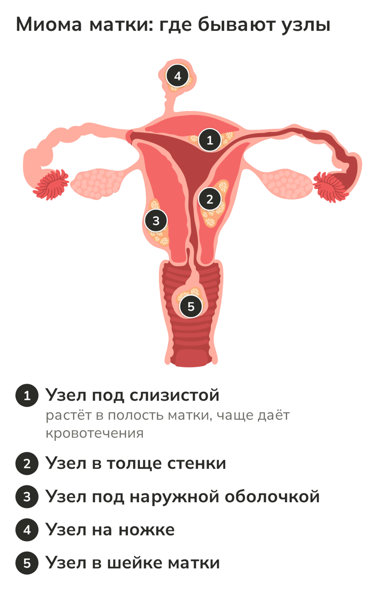 Анатомическая схема матки с узлами миомы разной локализации