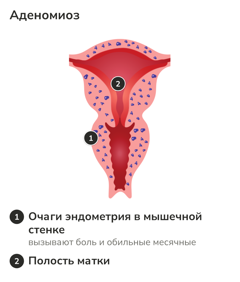 Анатомическая схема матки при аденомиозе
