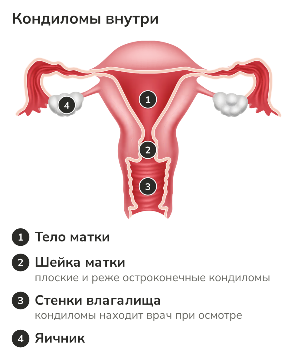 Схема: шейка матки и стенки влагалища, где бывают кондиломы