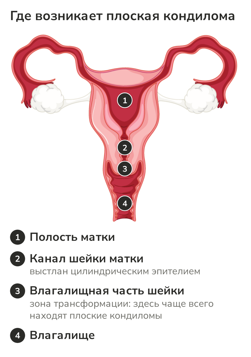 Схема: где на шейке матки возникает плоская кондилома