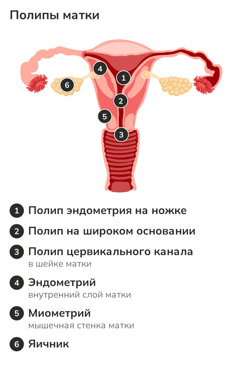 Анатомическая схема матки с полипами эндометрия