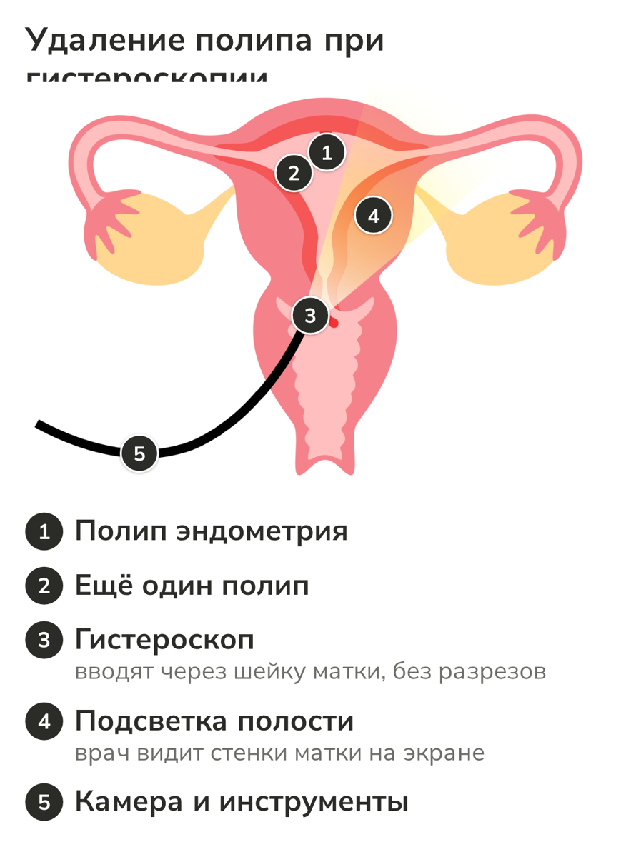 Схема удаления полипа эндометрия при гистероскопии