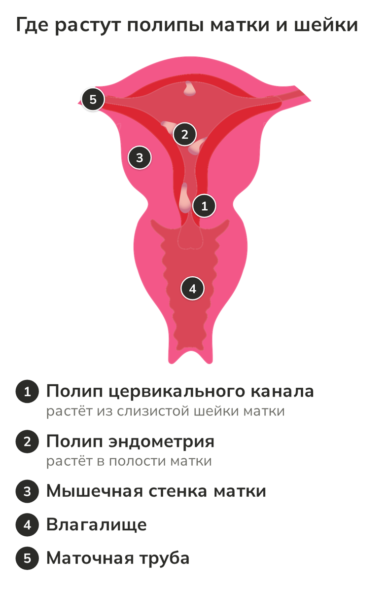 Схема матки: полип цервикального канала и полипы эндометрия