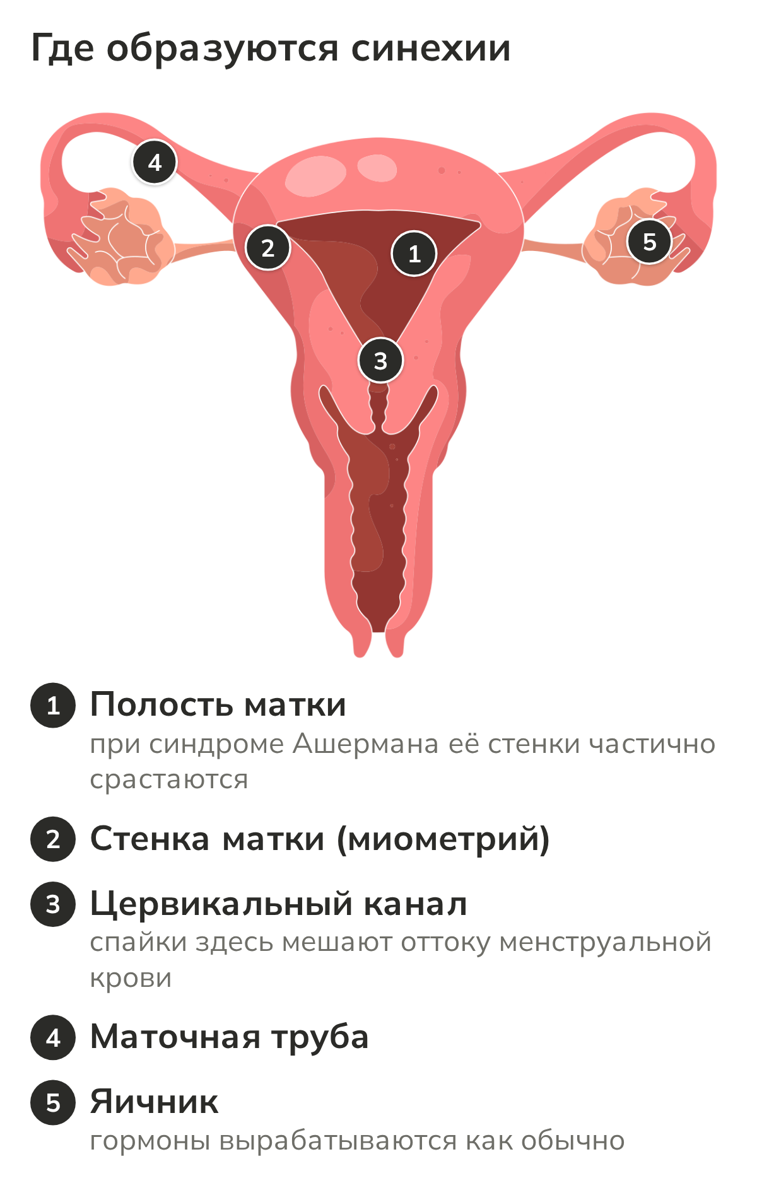 Строение матки: полость, где образуются синехии, стенка матки, цервикальный канал, маточная труба и яичник