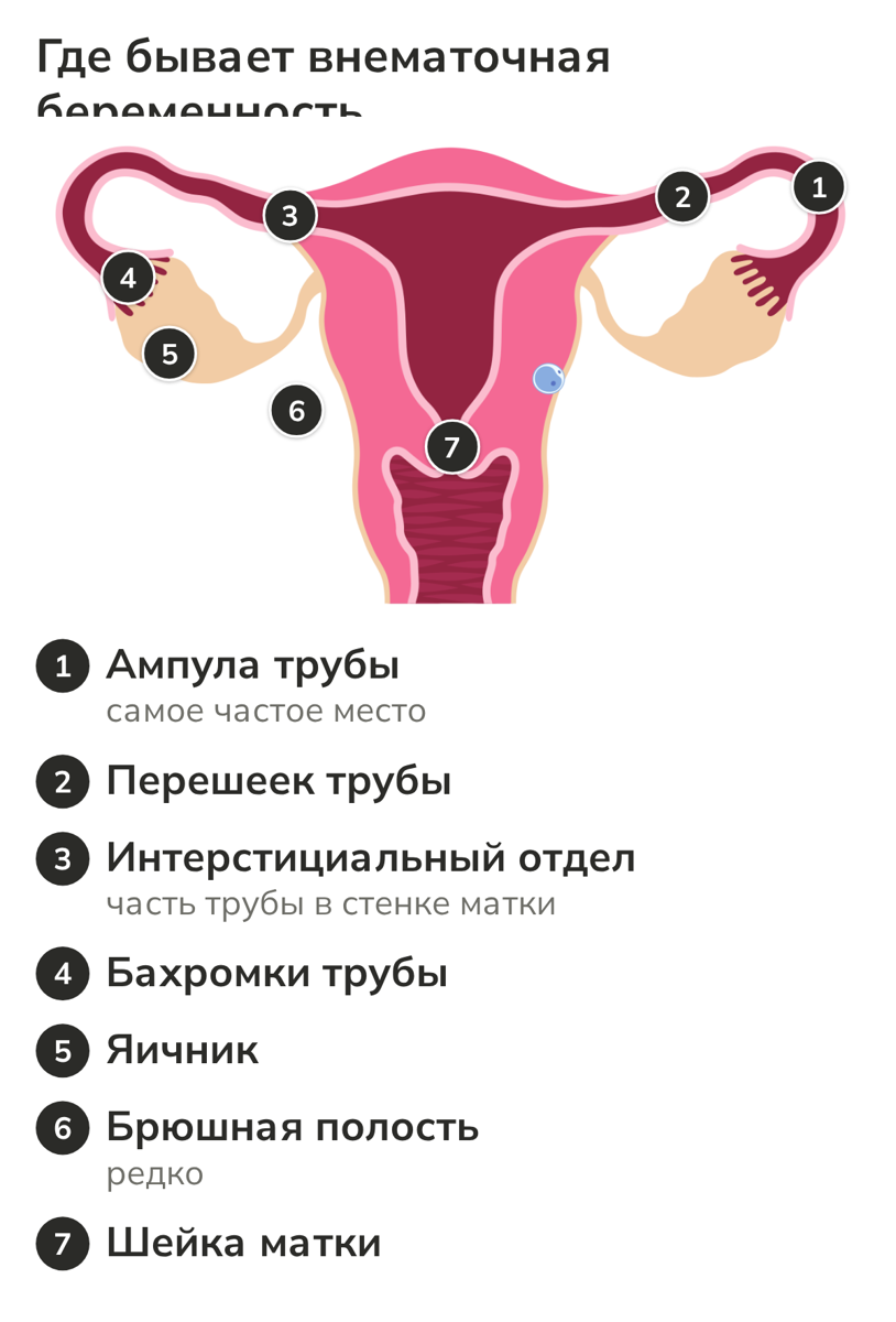 Схема матки и придатков: места, где может закрепиться внематочная беременность