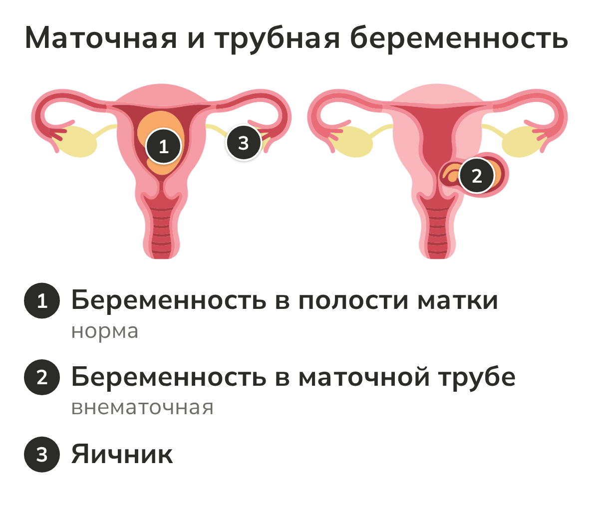 Сравнение беременности в полости матки и трубной беременности