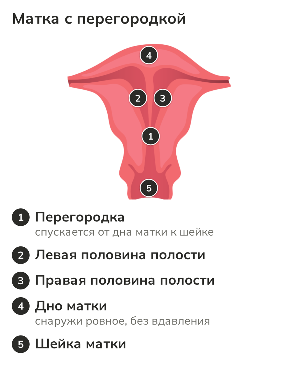 Матка с перегородкой: перегородка, две половины полости, дно и шейка матки