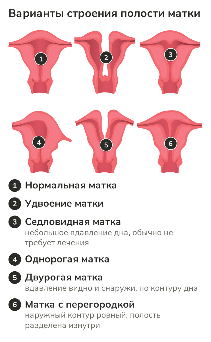 Варианты строения матки: норма, удвоение, седловидная, однорогая, двурогая матка и матка с перегородкой