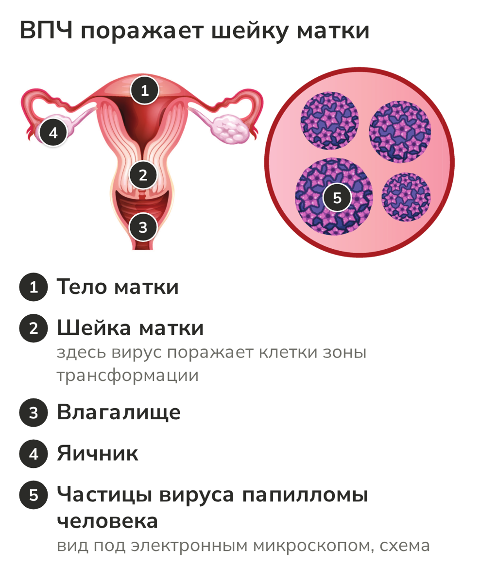 Схема: ВПЧ поражает шейку матки, строение матки и частицы вируса