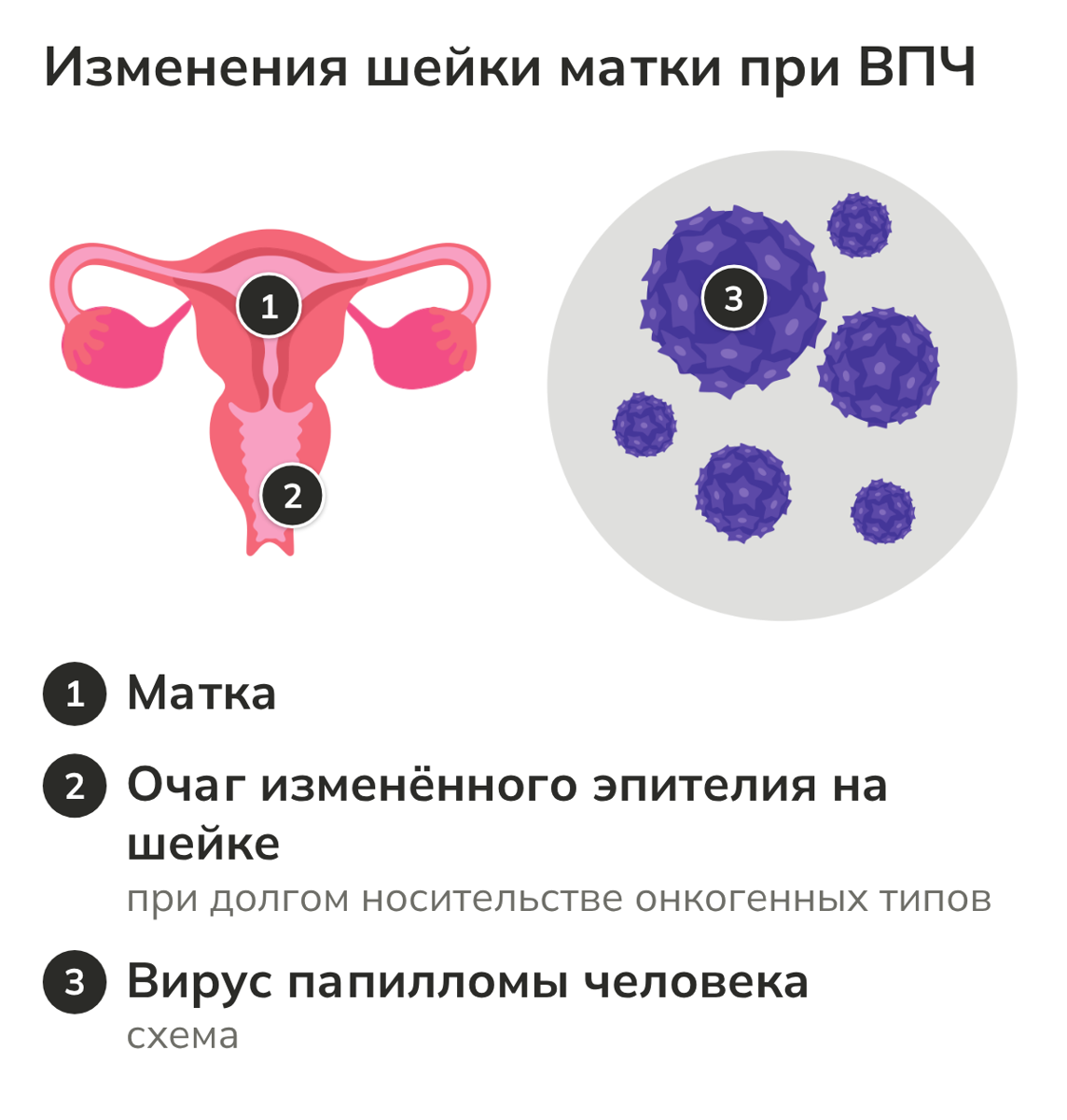 Схема: очаг изменённого эпителия на шейке матки при ВПЧ
